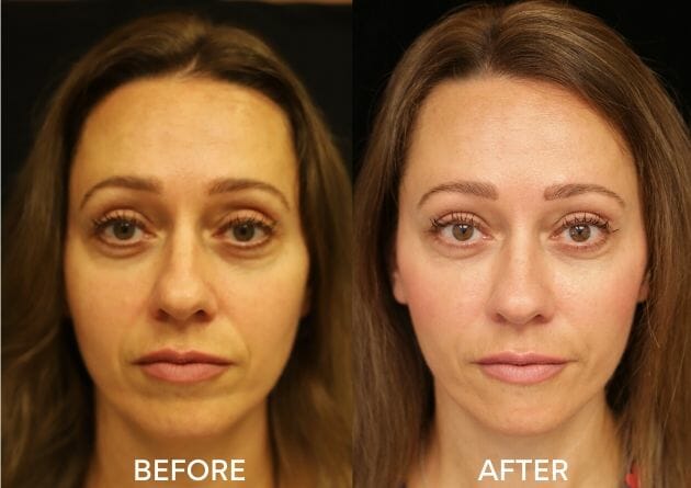 juvederm facial fillers before and after