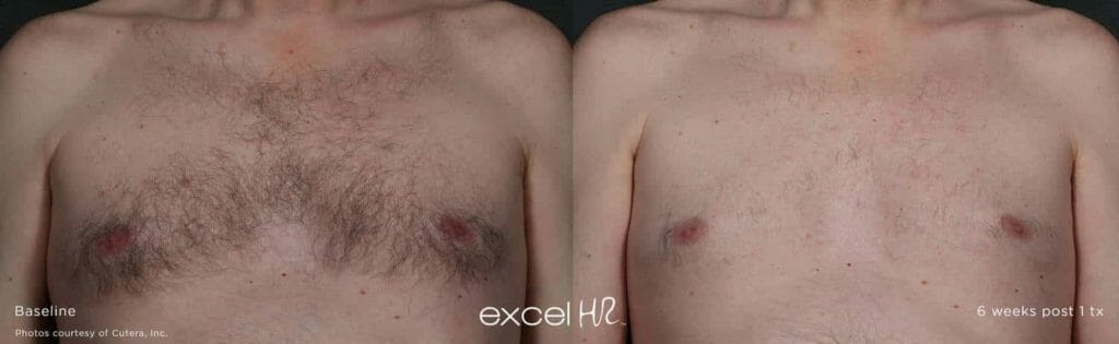 excel HR laser hair removal Edmonton