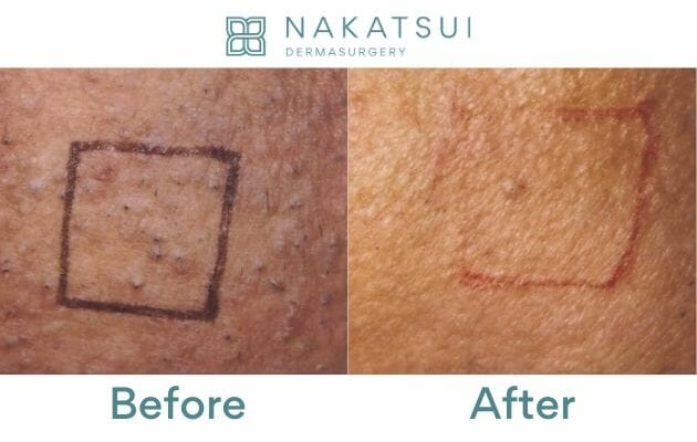 Laser Hair Removal Edmonton Dermatology Nakatsui DermaSurgery