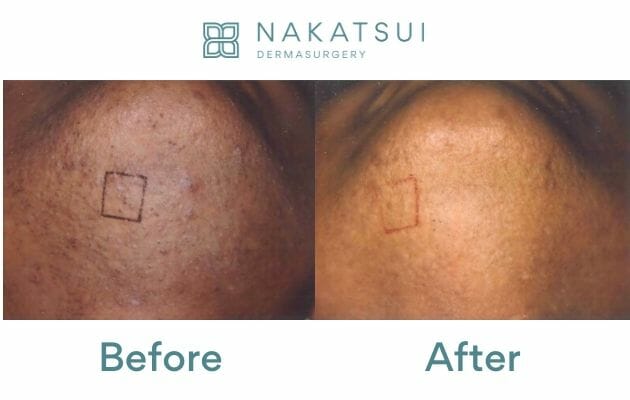 Laser Hair Removal Edmonton Dermatology Nakatsui DermaSurgery