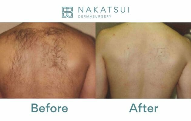 laser hair removal back before and after edmonton