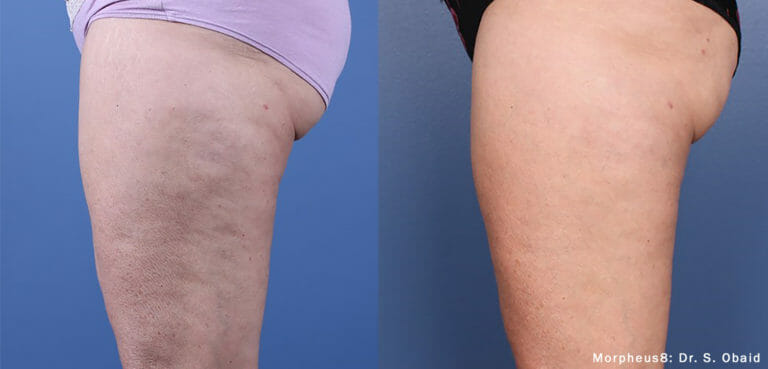Morpheus8 RF microneedling | Edmonton | Nakatsui DermaSurgery