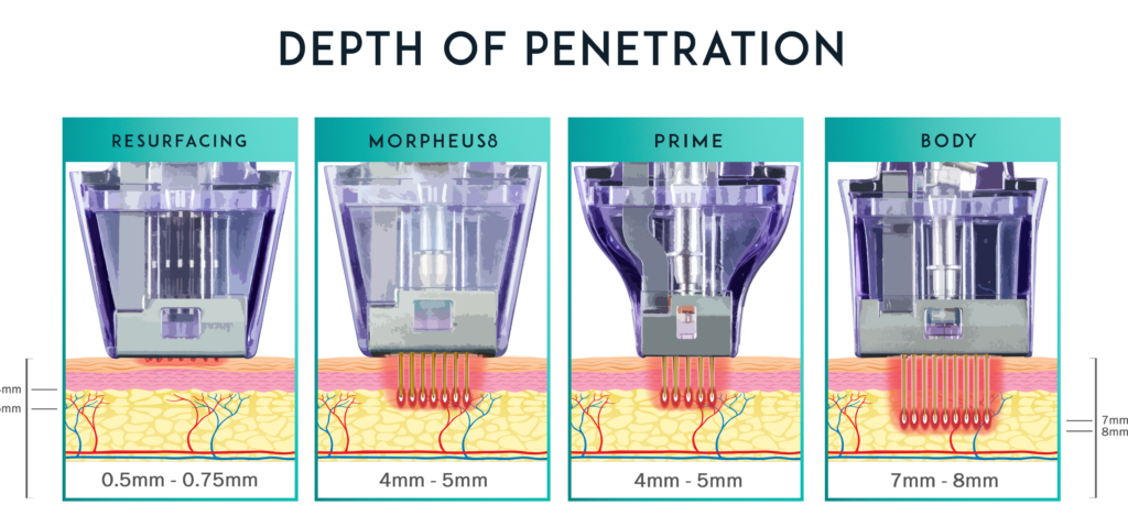 RF microneedling treatment depth chart