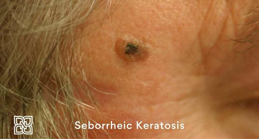 seborrheic keratosis dermatology