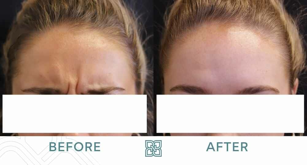 Botox Glabella Edmonton before and after