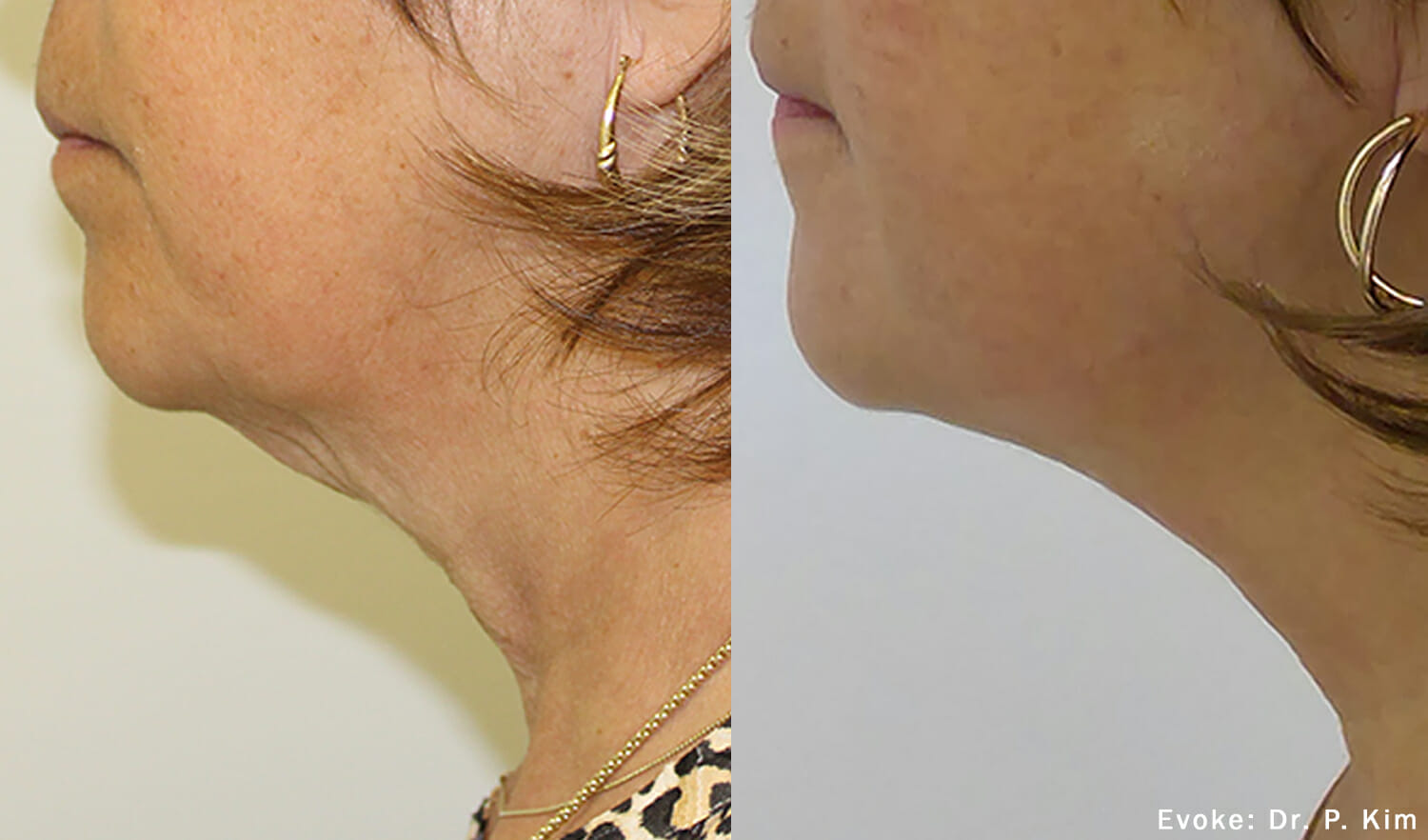 Evoke Facial Remodeling Edmonton Nakatsui DermaSurgery