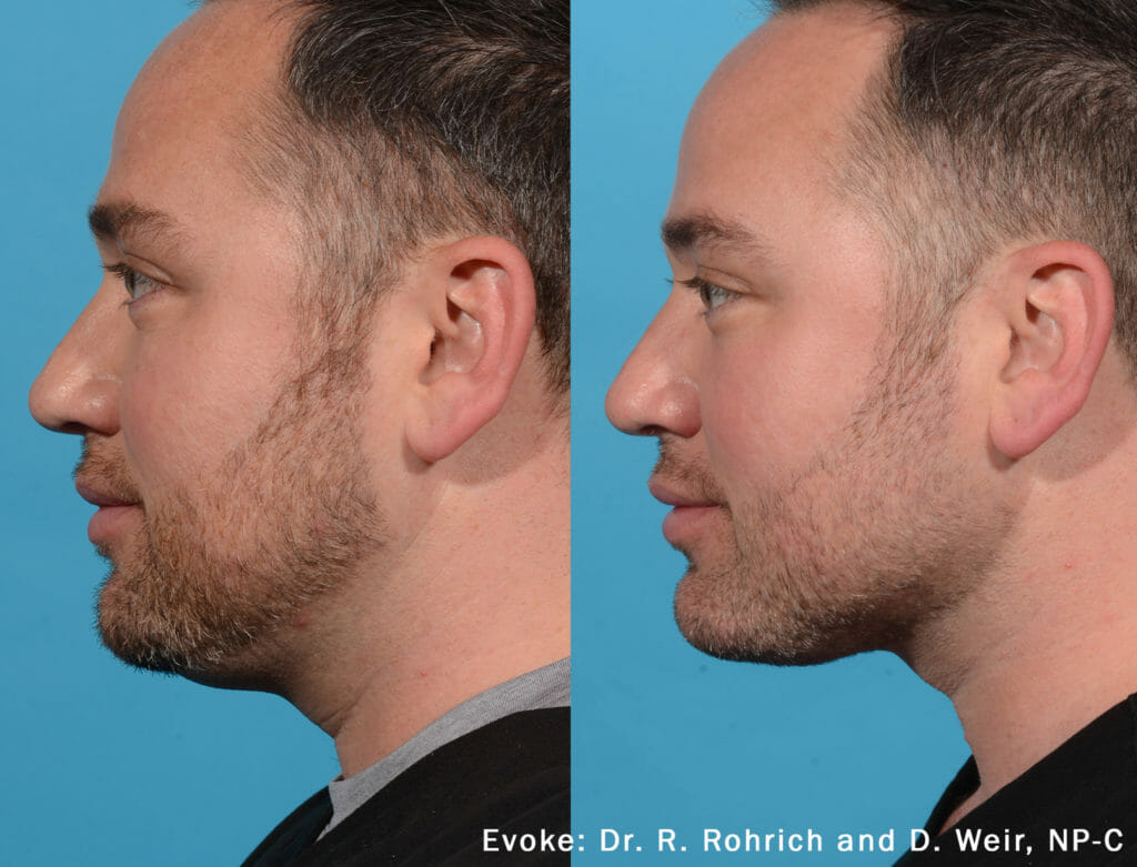 evoke before and after neck contouring Edmonton male