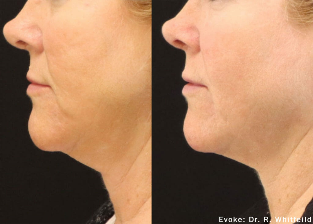evoke rf neck female before and after