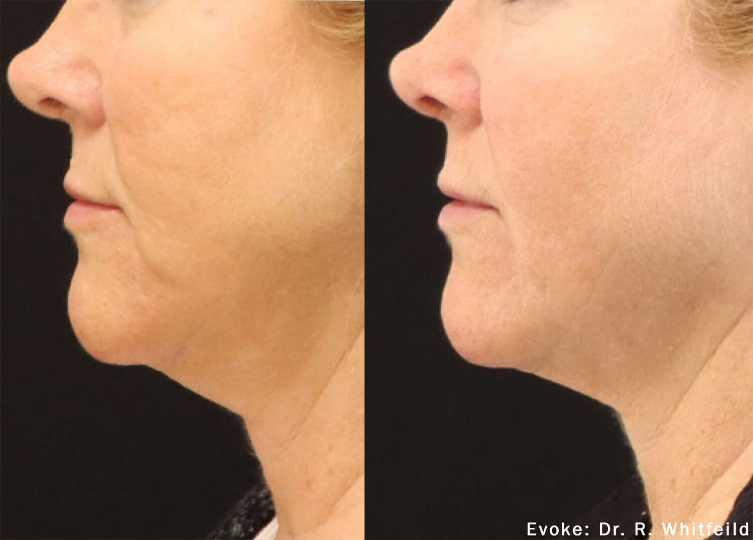 Evoke Facial Remodeling Edmonton Nakatsui DermaSurgery