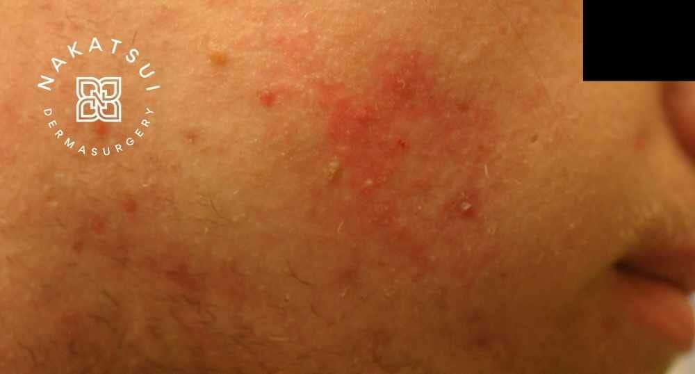 acne treatment clinic edmonton
