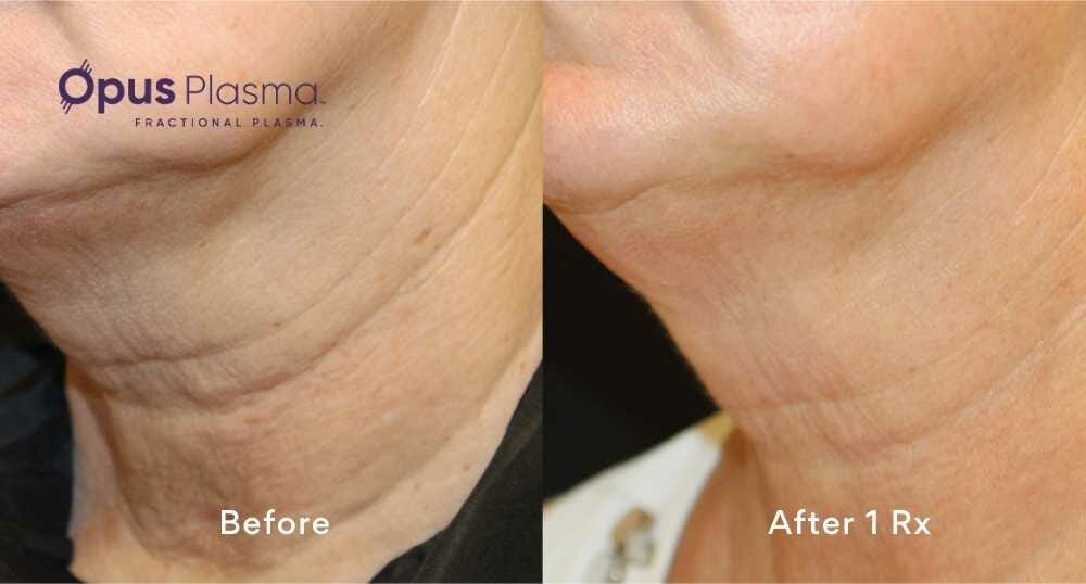 before and after neck rejuvenation edmonton