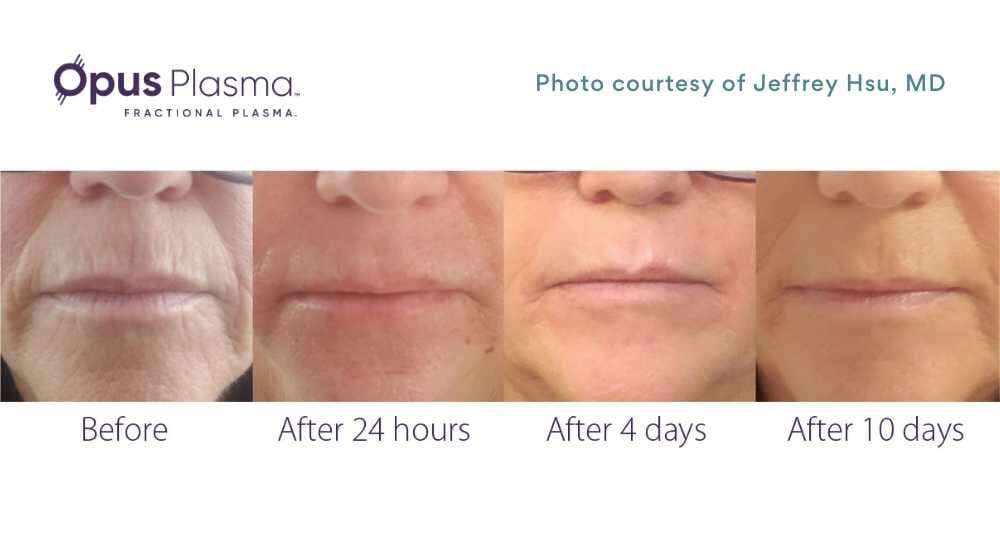 befroe and after photos of plasma resurfacing of the perioral wrinkles