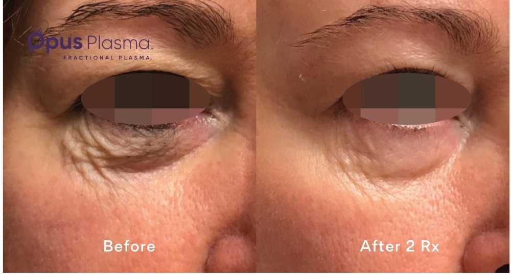 before and after photos of eyelid plasma resurfacing edmonton opus