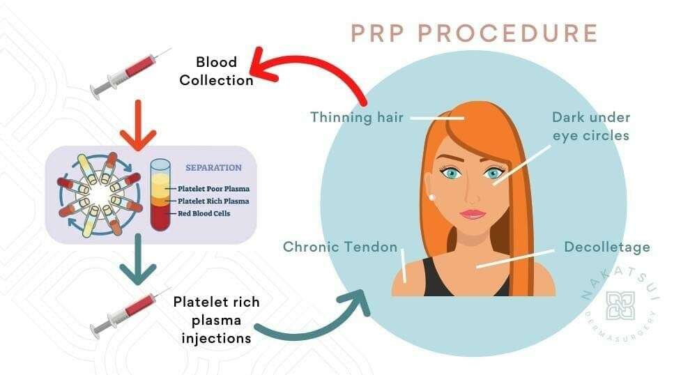 diagram of prp injection therapy edmonton