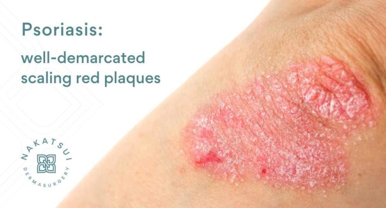 Psoriasis | Edmonton Dermatology │ Nakatsui DermaSurgery