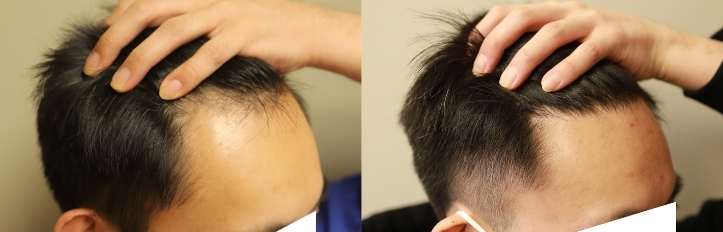 asian hair transplant edmonton hairline before and after