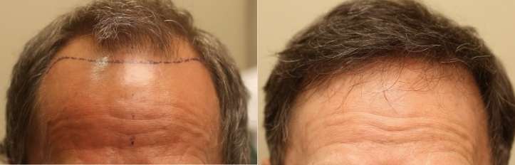 frontal hairline hair restoration