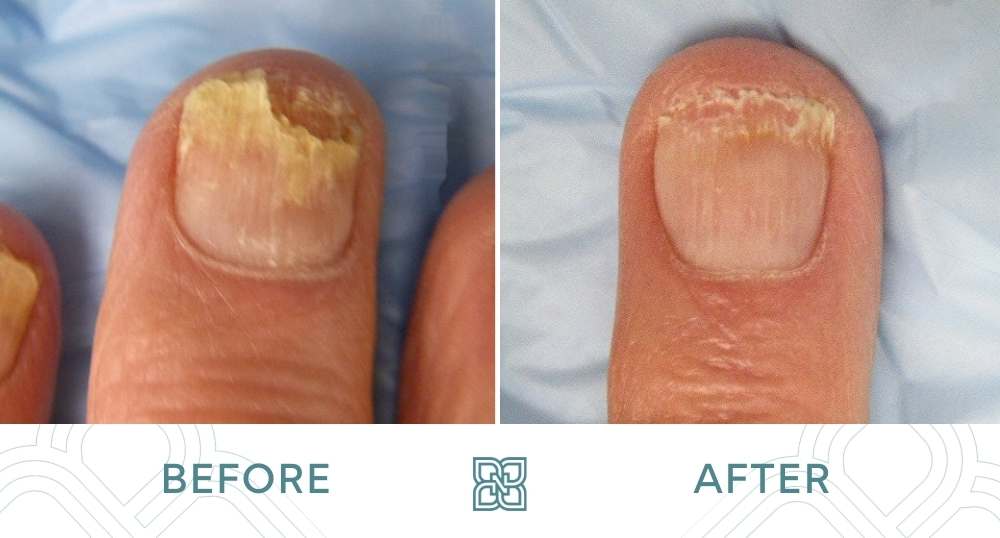 Toenail Fungus Removal in Boston & Newburyport | Suite six Medical  Aesthetics