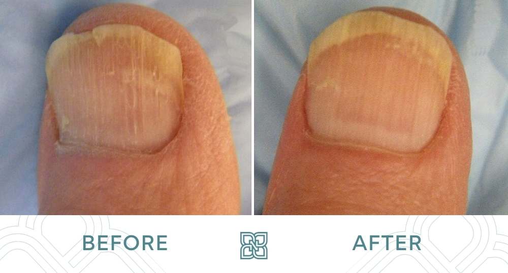 Laser And Onyfix Nail Treatment in Arlington, VA | Arlington Foot and Ankle