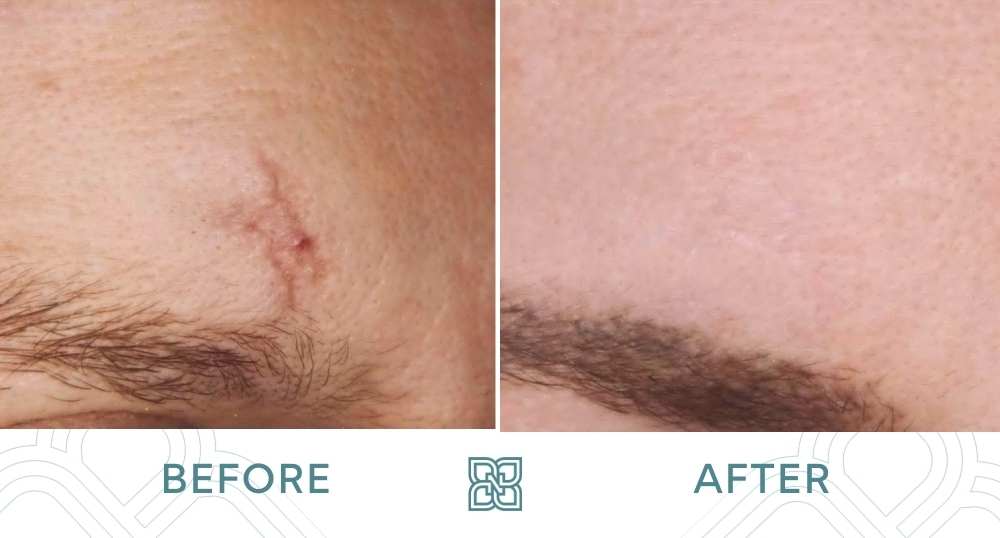 Scar Removal Before and After Pictures