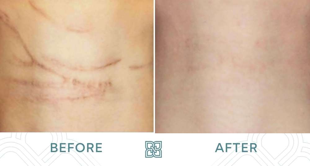 scar removal before and after photo