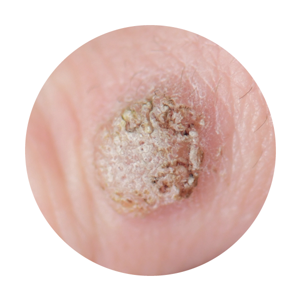 sample of Common Warts