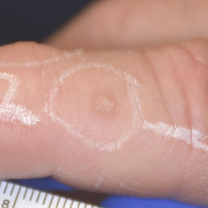 finger wart before cellfx treatment