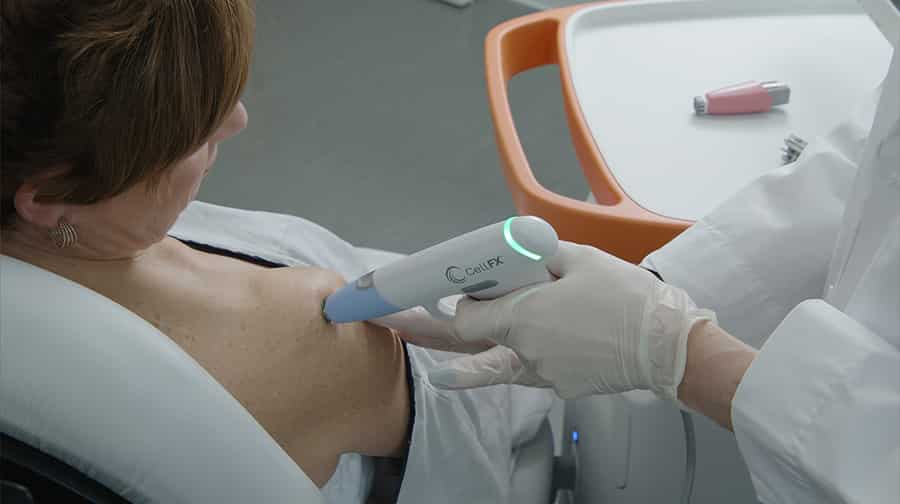 cellfx wart treatment being administered