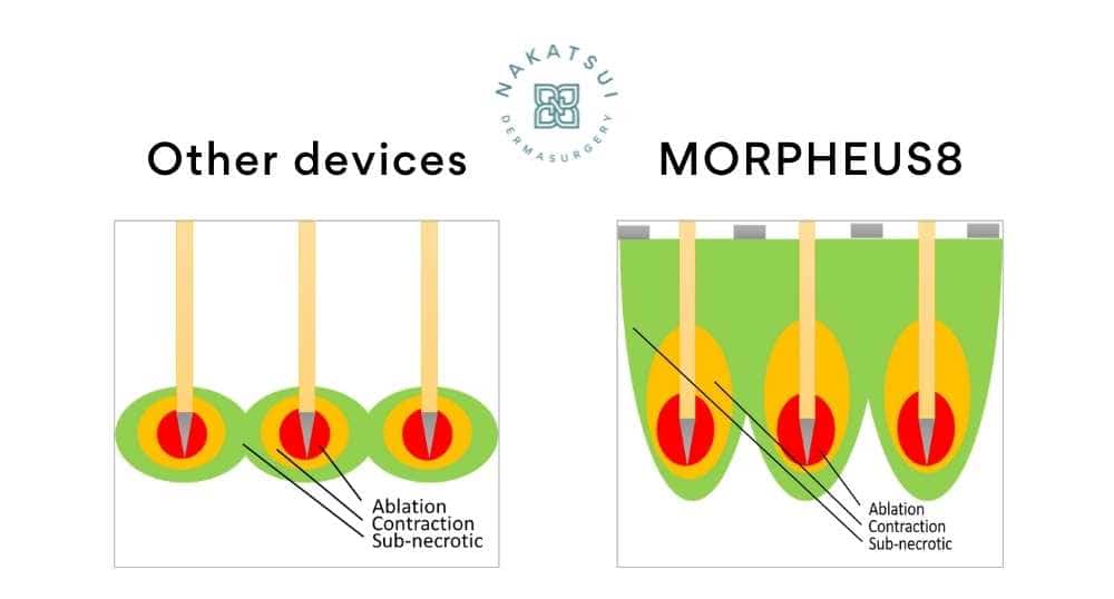 Morpheus8 vs other RF microneedling devices Edmonton