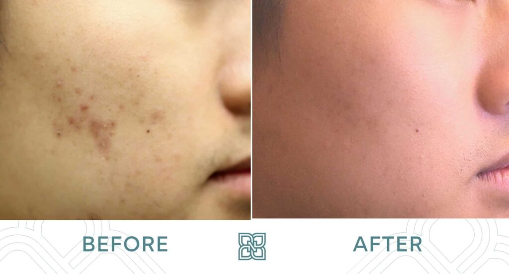 morpheus8 acne scarring edmonton before and after