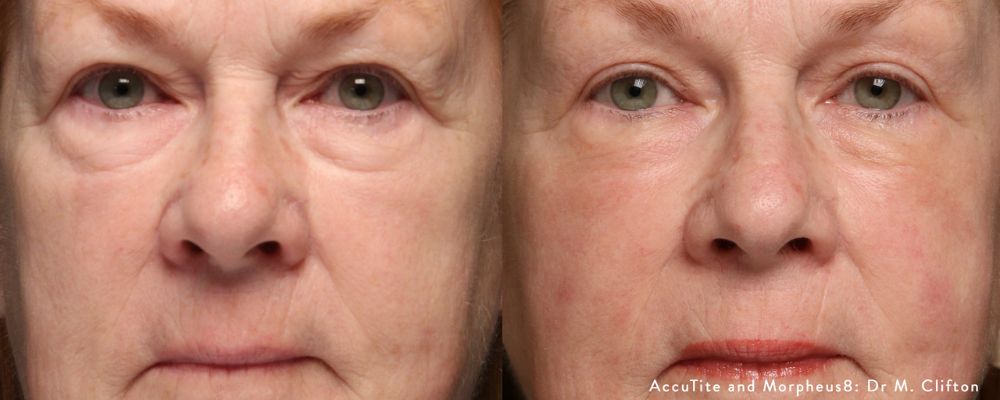 Accutite Skin Tightening Edmonton before and after eyelids