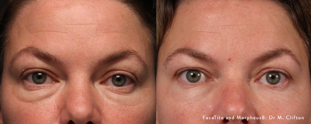 Accutite and Facetite Skin tightening Edmonton lower eyelids before and after