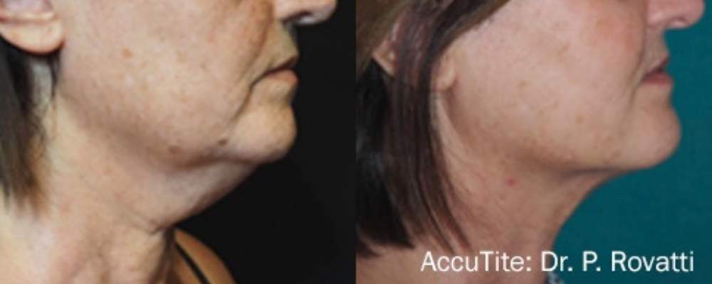 Accutite Skin Tightening Edmonton before and after neck