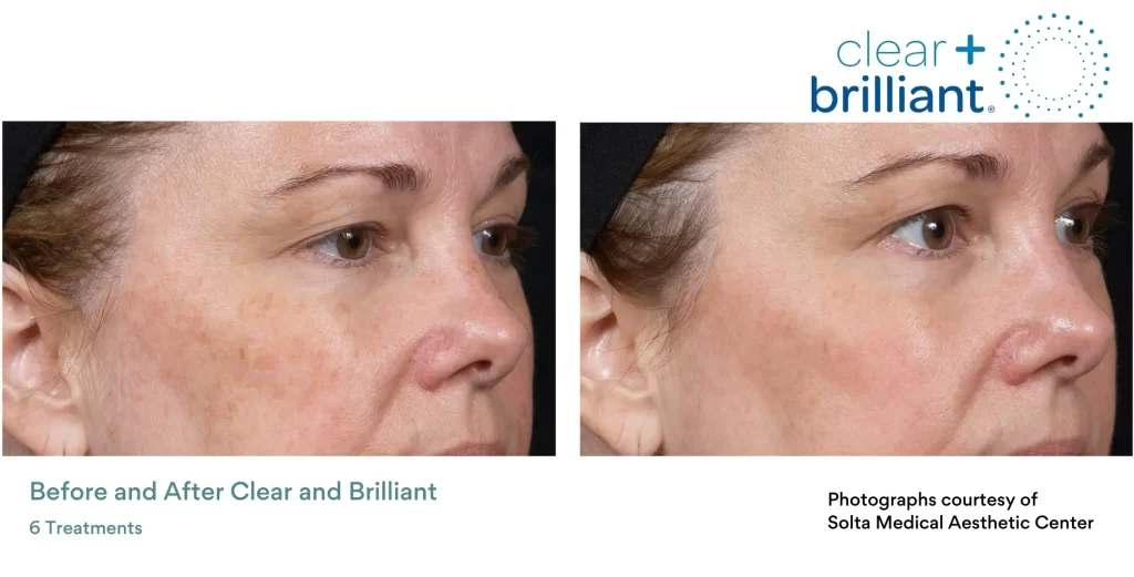 clear and brilliant laser closeup before and after photos edmonton dermatology