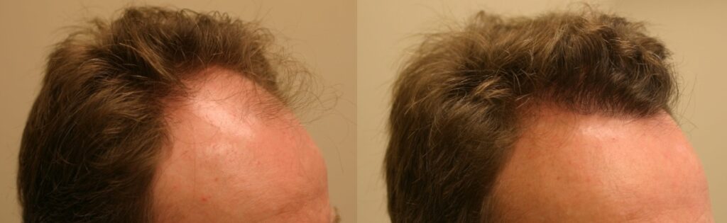 Frontal scalp hair restoration Edmonton 