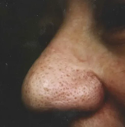patient with telangiectasia and rhinophyma on nose after laser