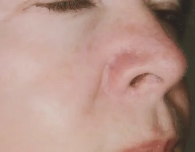patient with facial veins on cheek and nose after laser treatment