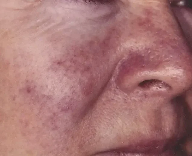 patient with facial veins on cheek and nose before laser treatment
