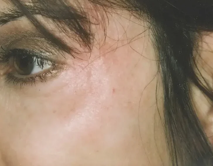 periorbital blue veins after treatment with laser