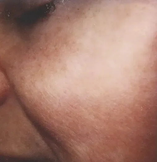 telangiectasia on cheeks after treatment with laser