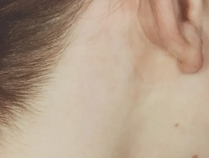 telangiectasia on neck after treatment with laser