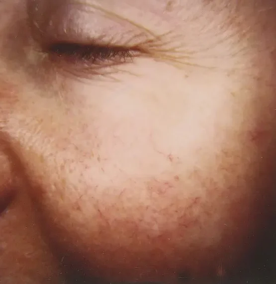 telangiectasia on cheeks before treatment with laser