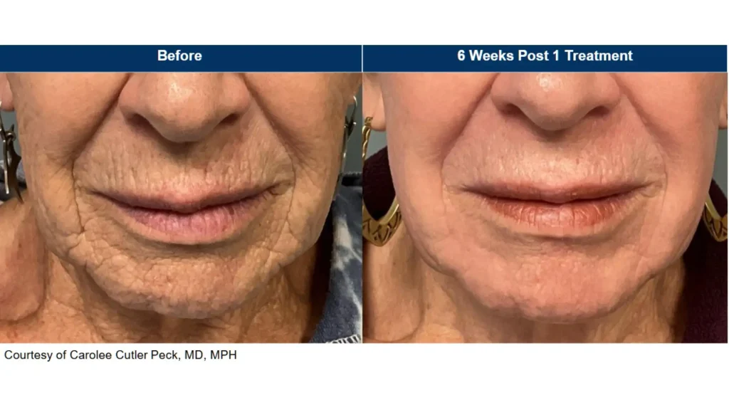 UltraClear laser with laser coring for resurfacing lines around the mouth before and after