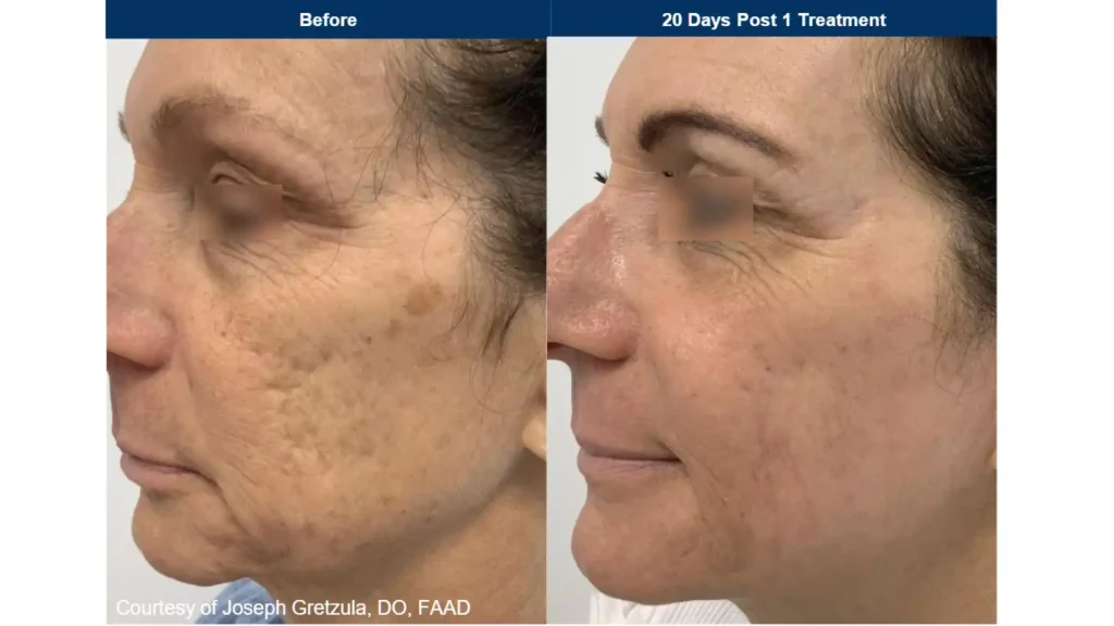 UltraClear laser for acne scarring and brown pigmentation before and after
