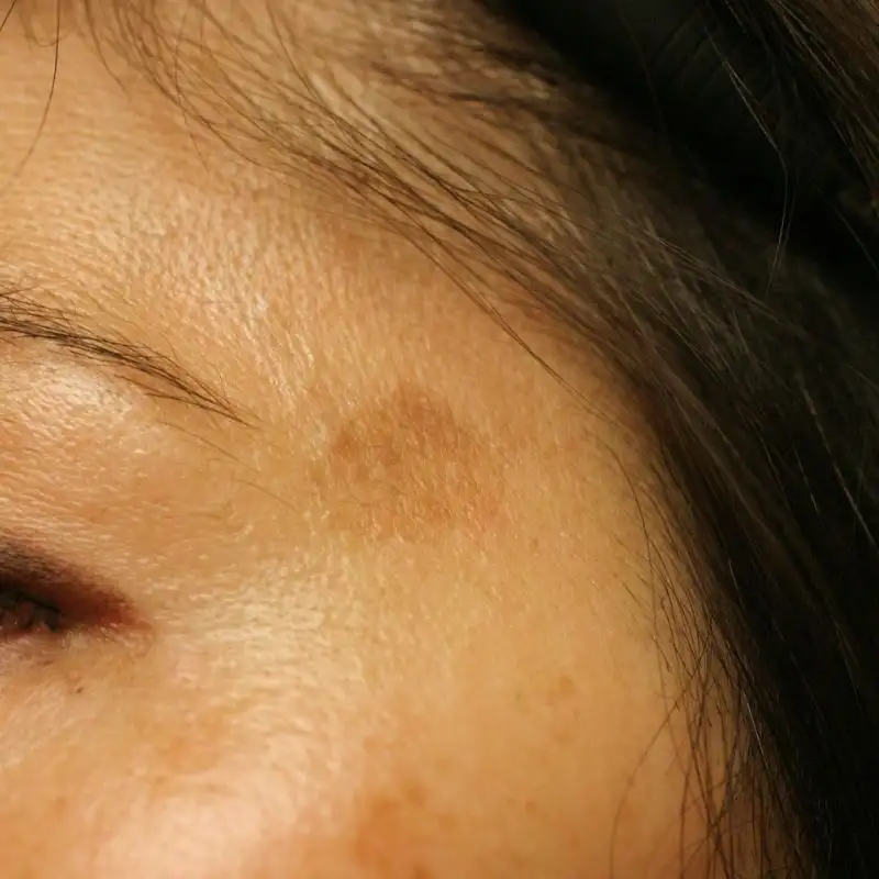 face with brown pigmentation liver spot