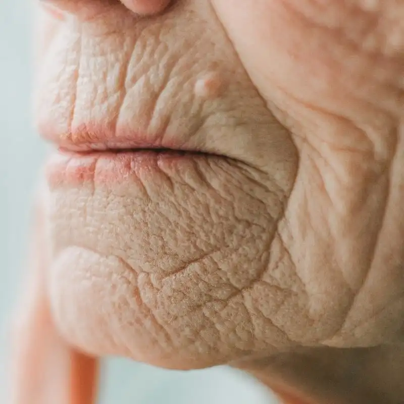 face with extensive perioral wrinking