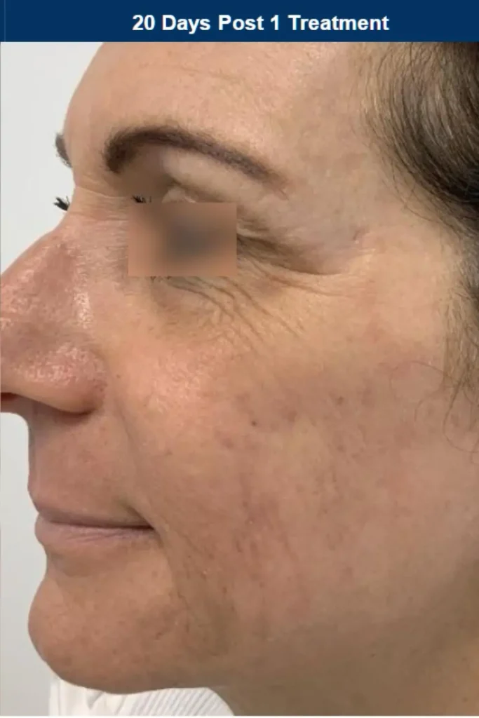 after photo of ultraclear laser for acne scarring in patient with skin of color