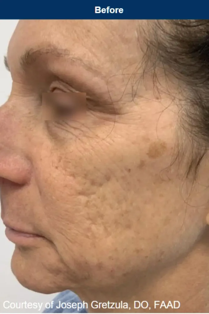 before photo of acne scarring in patient with skin of color