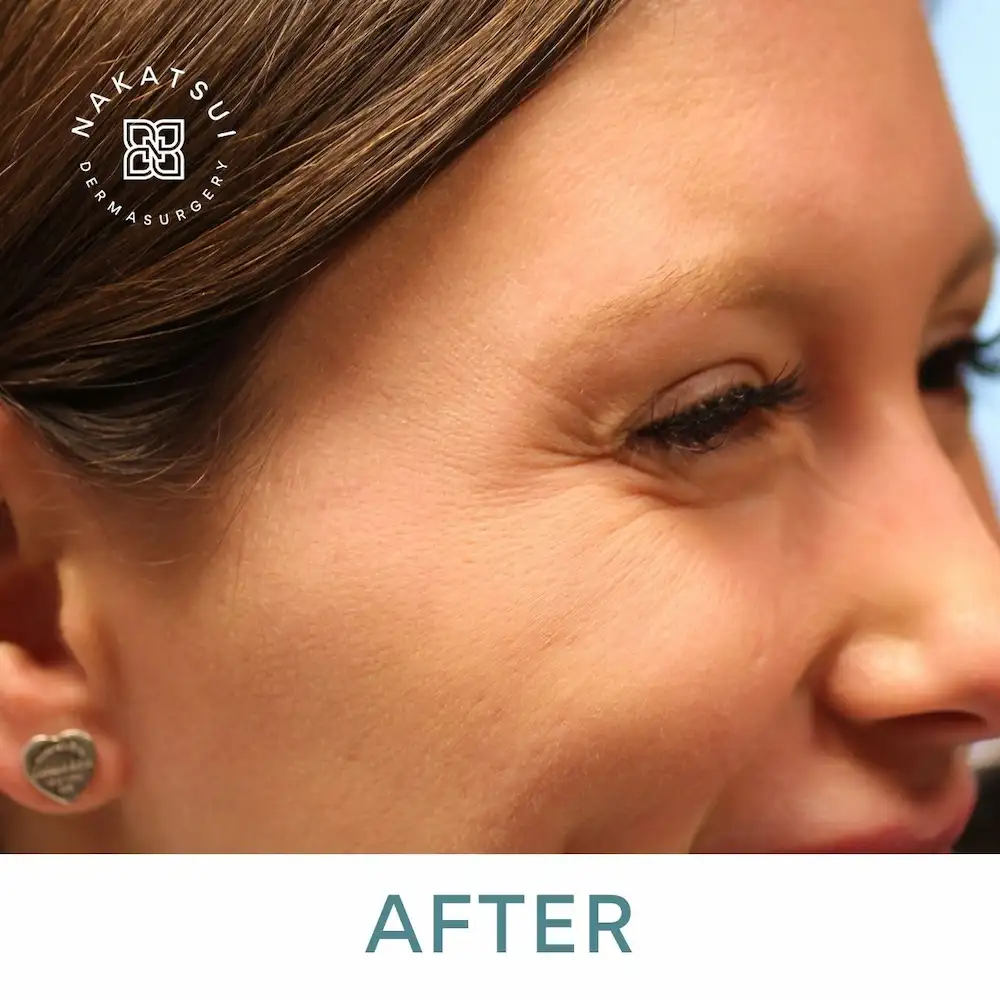 botox smile lines crow's feet around and under eyes after