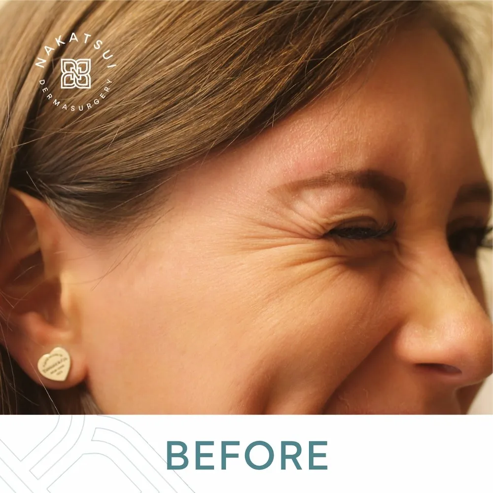 botox smile lines crow's feet around and under eyes before